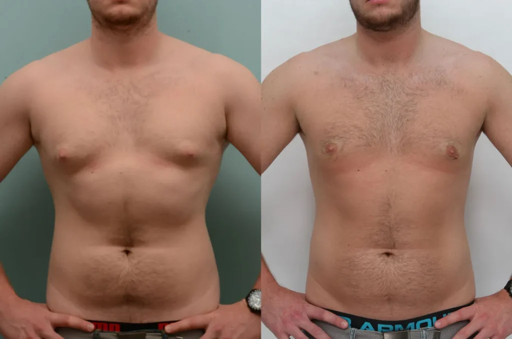 Before and after male body contouring showing refined torso shape and improved upper body balance
