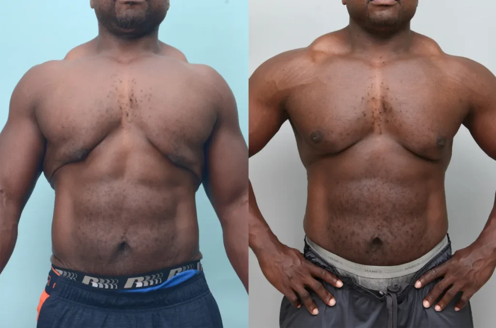 Before and after male body contouring showing refined torso shape and improved upper body balance | Gynecomastia treatment results at Ditesheim Cosmetic Surgery Charlotte