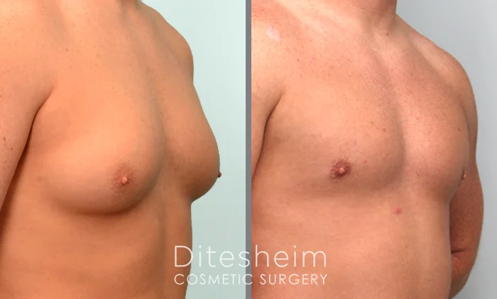 Gynecomastia body builder before and after prohormone correction copy