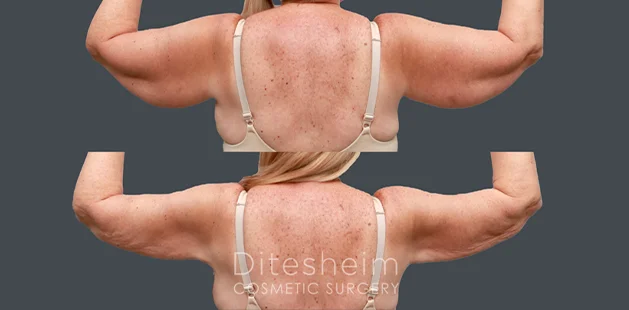 Arm lipedema treatment results at Ditesheim Cosmetic Surgery Charlotte