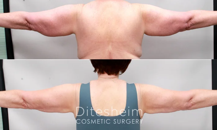 Before and after arm lipedema treatment revealing reduced swelling and improved upper arm definition