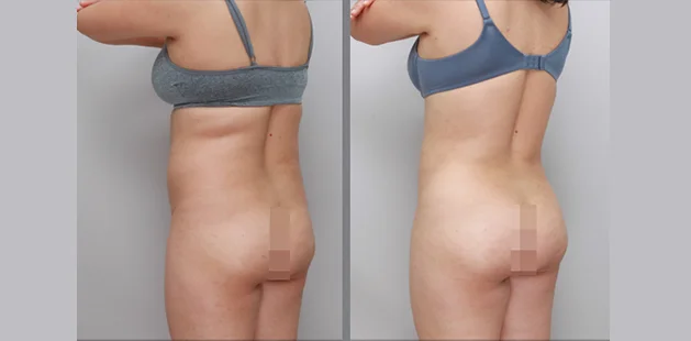 Post-weight loss tummy tuck 360 results showing firmer, more defined midsection and lower body | Ditesheim Cosmetic Surgery Charlotte