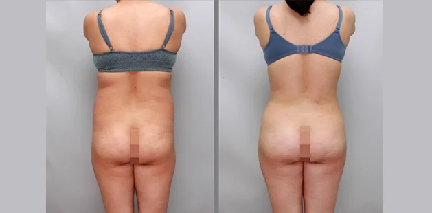 360 tummy tuck after major weight loss revealing smoother back and lifted body contours | Ditesheim Cosmetic Surgery Charlotte