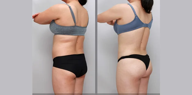 Before and after tummy tuck 360 results after weight loss showing enhanced waistline and improved skin tightness