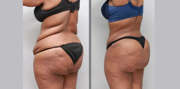 Before and after tummy tuck 360 results after weight loss showing enhanced waistline and improved skin tightness | Ditesheim Cosmetic Surgery Charlotte