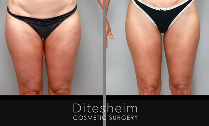 Before and after thigh lipedema surgery showing smoother, slimmer leg contours and improved symmetry