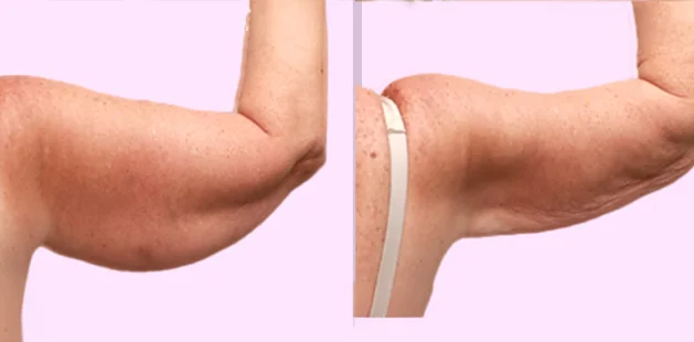 Before and after arm lipedema surgery showing smoother, more toned upper arms and reduced swelling