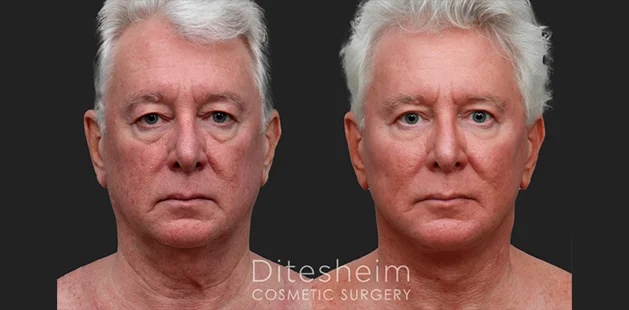 Before and after facial rejuvenation highlighting reduced sagging and restored skin tone | Facelift results at Ditesheim Cosmetic Surgery Charlotte