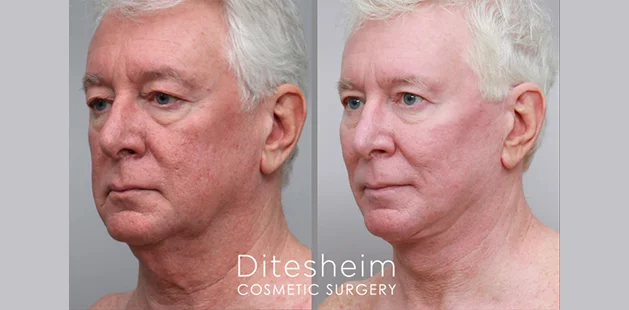Before and after facelift and neck lift showing lifted features and smoother neckline | Facial rejuvenation results at Ditesheim Cosmetic Surgery Charlotte
