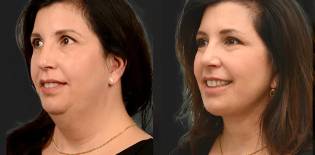 Before and after deep plane neck lift showing refined jawline, lifted lower face, and smoother neckline – Ditesheim Cosmetic Surgery Charlotte NC.