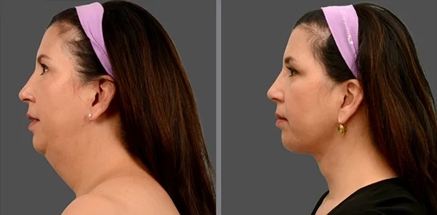 Before and after neck lift results on 50-year-old woman showing smoother neckline, reduced sagging, and refined jawline – Ditesheim Cosmetic Surgery Charlotte NC.