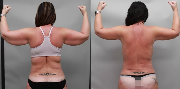 Brachioplasty with Renuvion results showing lifted and contoured arms.