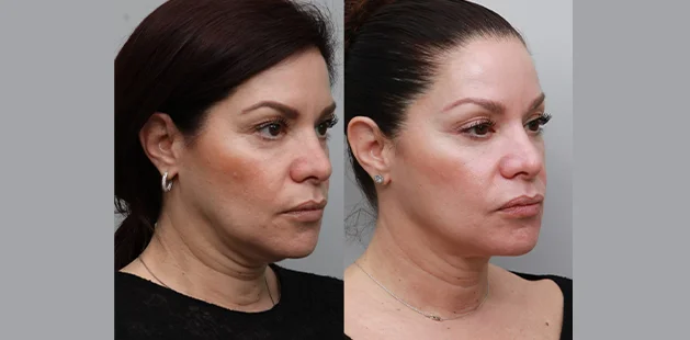 Before and after Renuvion treatment on a 57-year-old woman, highlighting a smoother neckline, tighter jawline, and more youthful lower face – Ditesheim Cosmetic Surgery in Charlotte, NC.