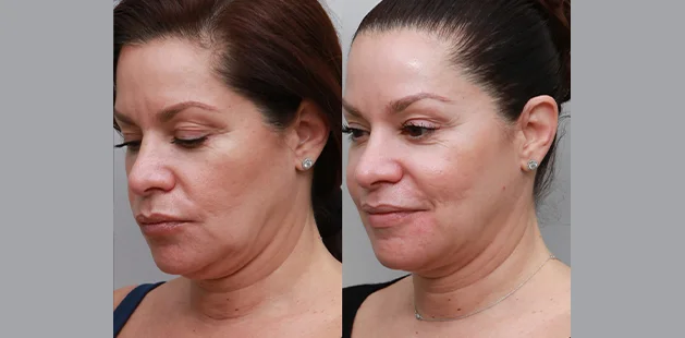 Before and after Renuvion neck and jawline tightening on 57-year-old woman showing smoother neckline, firmer skin, and rejuvenated lower face – Ditesheim Cosmetic Surgery Charlotte NC.