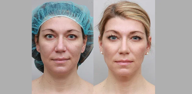 Before and after Renuvion neck tightening on 41-year-old woman showing smoother neckline, firmer jaw contour, and rejuvenated lower face – Ditesheim Cosmetic Surgery Charlotte NC.