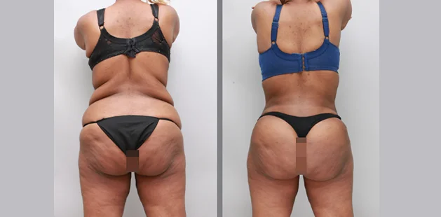 Before and after tummy tuck 360 after weight loss showing tighter, smoother contours and lifted lower body results | Ditesheim Cosmetic Surgery Charlotte