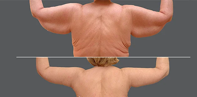 rm lipedema surgery results showing smoother contour and decreased fat buildup | Ditesheim Cosmetic Surgery Charlotte