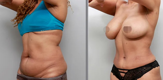 Plastic surgery before and after results showing full-body contouring for moms.