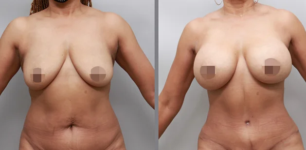 Before and after body contouring and breast enhancement after pregnancy.