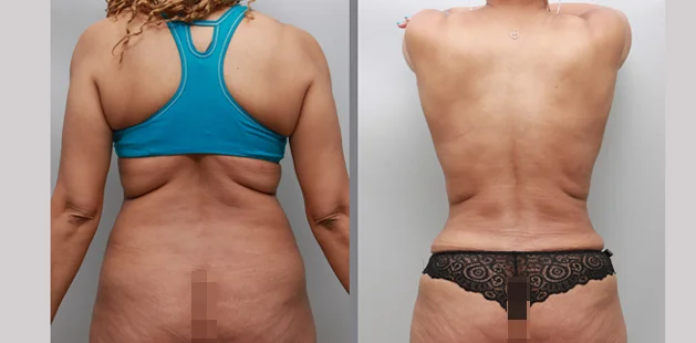 Comprehensive mommy makeover showing improved waistline, back view.