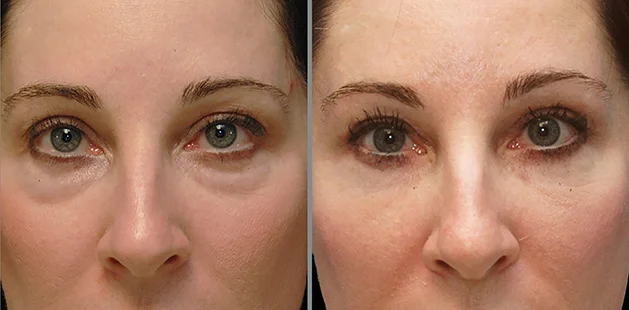 Before and after eyelid lift demonstrating brighter eyes and refreshed upper face appearance | Facial plastic surgery results at Ditesheim Cosmetic Surgery Charlotte