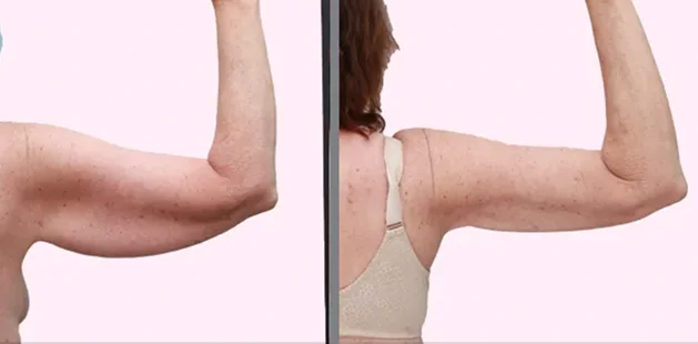 arm back