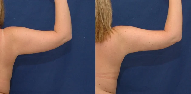 Before and after arm lipedema treatment revealing reduced swelling and improved upper arm definition | Ditesheim Cosmetic Surgery Charlotte