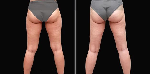 Before and after lipedema surgery displaying smoother skin texture, improved contour, and reduced bulkiness