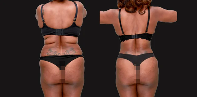 Before and after buttock enhancement surgery showing lifted, smoother appearance.
