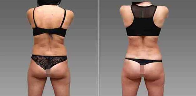 Before and after buttock enhancement surgery showing lifted, smoother appearance.