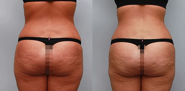 Mommy makeover showing restored body shape and tighter abdomen.