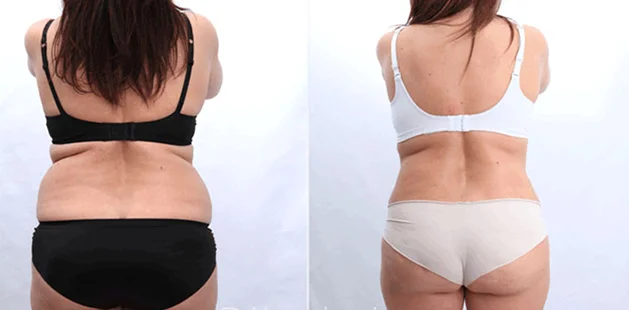 Tummy tuck before and after results for post-pregnancy transformation, back view.