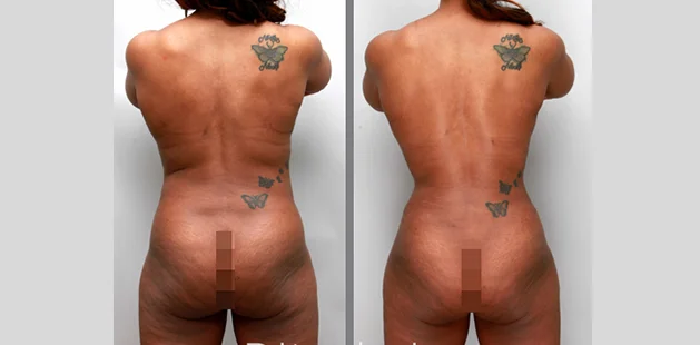 Comprehensive mommy makeover showing improved waistline.