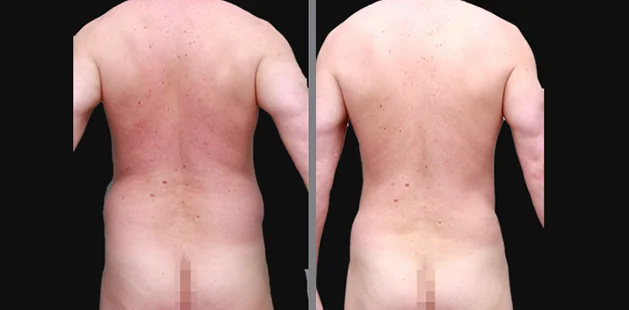 Back view of male liposuction results showing reduced fat and improved back contour.