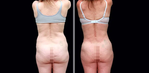 Plastic surgery before and after results showing full-body contouring for moms, back side view.