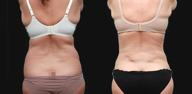 Mommy makeover showing restored body shape and tighter abdomen.