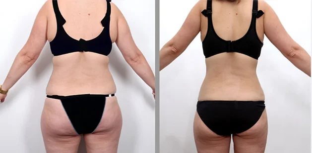 Liposuction before and after results demonstrating slimmer, contoured abdominal area.