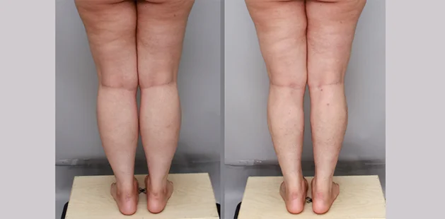 Before and after lipedema surgery showing improved lower leg contour and reduced swelling around calves and ankles – back view.