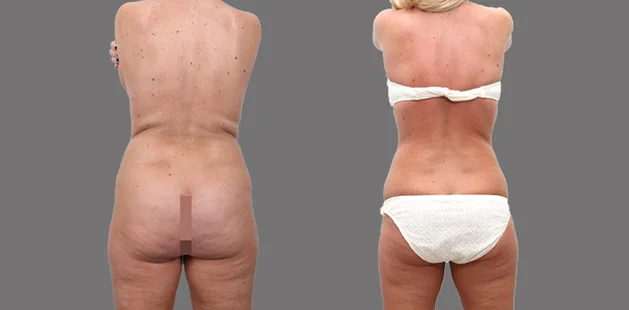 Body contouring results after buttock lift and augmentation for enhanced lower body shape.