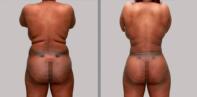 Body contouring results after buttock lift and augmentation for enhanced lower body shape.