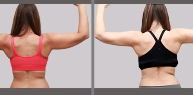 Before and after arm lipedema surgery showing smoother, more contoured upper arms | Ditesheim Cosmetic Surgery Charlotte