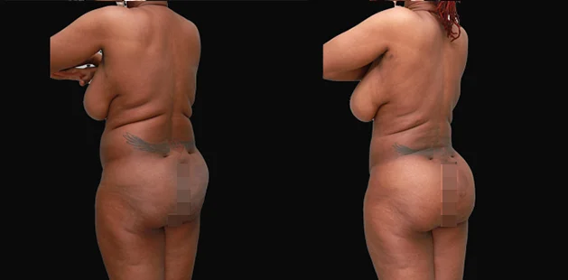 Plastic surgery before and after showing lifted, more defined buttocks and thighs.