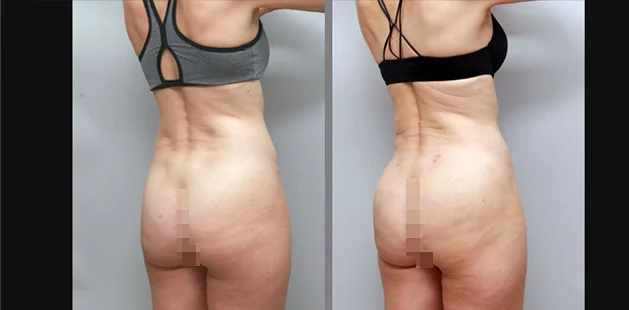 Before and after gluteal enhancement and lift showing natural body contour.