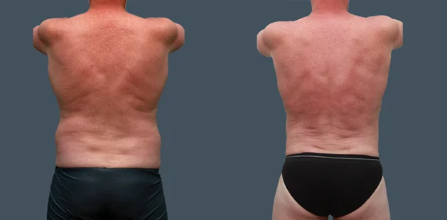 Male back liposuction before and after results showing reduced fat and improved definition at Ditesheim Surgery.