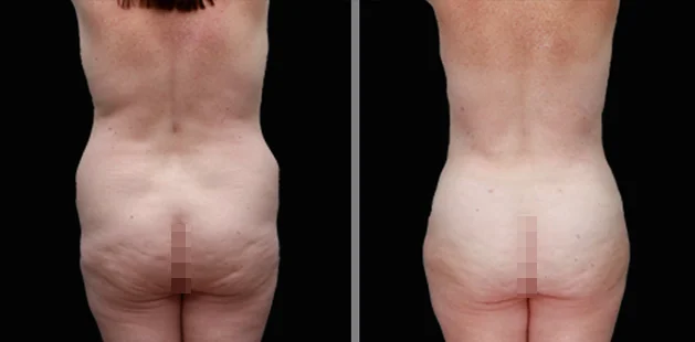 Before and after gluteal enhancement and lift showing natural body contour.