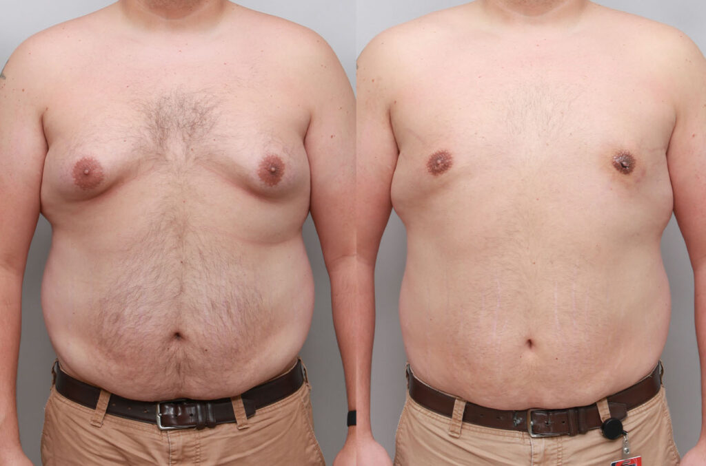 “Before and after male gynecomastia correction showing improved upper body contour and natural masculine appearance