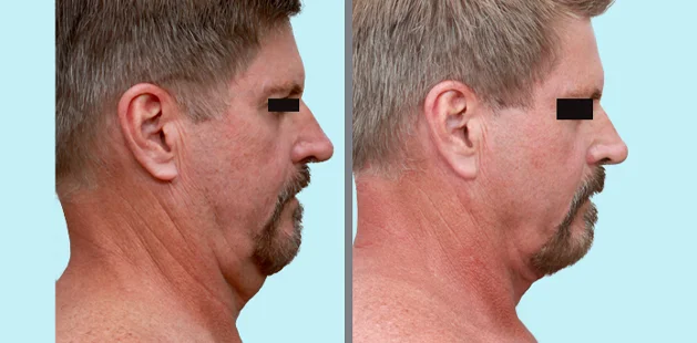 Male facial liposuction before and after, profile view showing improved jawline and neck contour.
