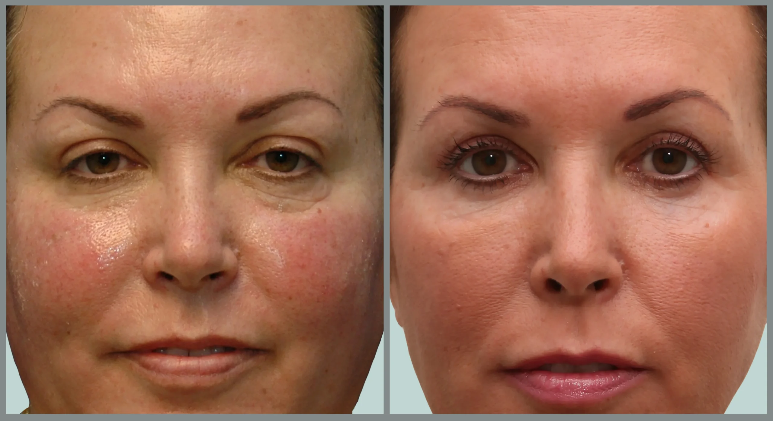 Before and after facelift and neck lift showing lifted features and smoother neckline | Facial rejuvenation results at Ditesheim Cosmetic Surgery Charlotte