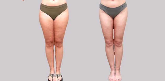 Patient age 41, 5'5 136 lbs, stage 1–2 leg liposuction results by Ditesheim Cosmetic Surgery, Charlotte North Carolina