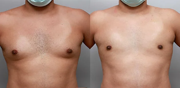 Front side view showing refined chest contour after gynecomastia surgery.